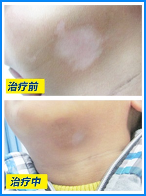 艾叶擦拭白斑真实案例