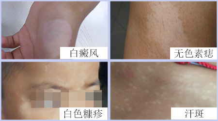 各种类型白斑高清图片对比
