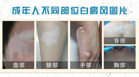 白斑早期的症状图片
