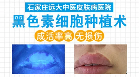 白癜风的黑色素种植手术疼不疼