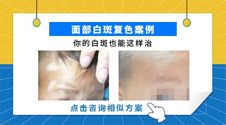 面部白癜风的复色率一般是多少