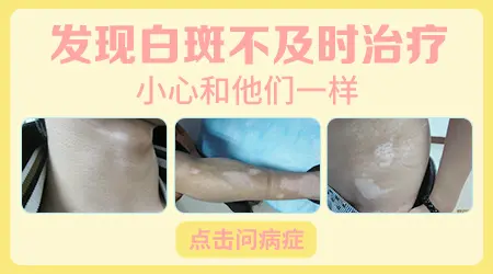 晕痣型白癜风能不能自愈