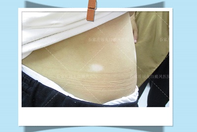 肚子上有白色斑块是怎么回事