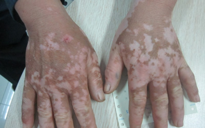 手上白斑的症状图片长什么样子