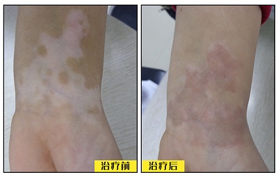 白癜风治疗效果好的效果图