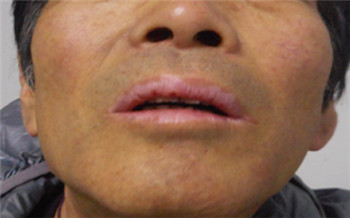 男性嘴部白癜风早期症状的图片