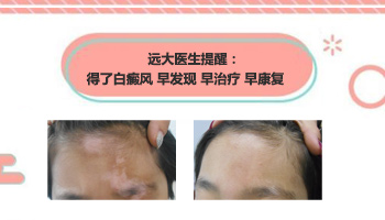 伍德氏灯照出来蓝白点点是什么病