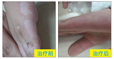 手上和脚上白癜风好多年了如何治疗