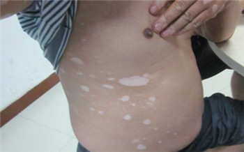 白斑ZUI早在肚子上后来胸也有发展很快