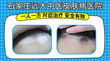 白斑检查结果能当天拿到吗