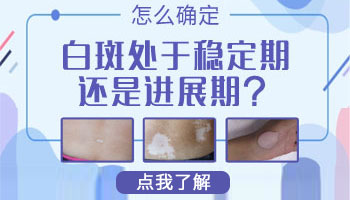 白癜风稳定期和扩散期有什么区别