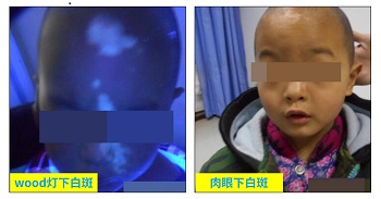 小孩白斑是什么病怎么确诊 【白斑要做哪些检查】