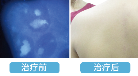 脸上脖子上前胸后背都是白癜风治得好吗