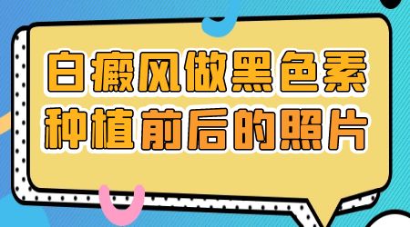 白癜风做移植手术多久有效果