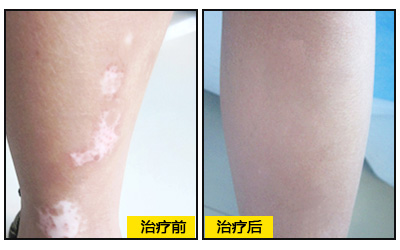 白斑好了毛发能恢复吗