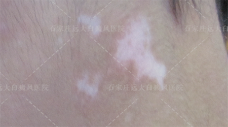 宝宝出生时腿上有一块白的是什么