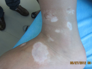 脚腕两边大腿根两边白癜风对称着长