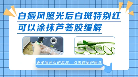 白癜风照光后又红又痒怎么回事