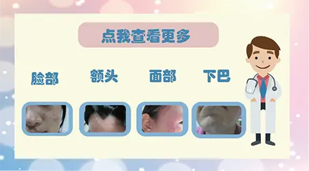 面部白癜风初期症状