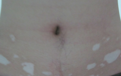 女性腹部有白斑是什么原因