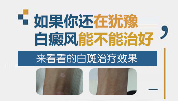 白斑半年了能治好吗