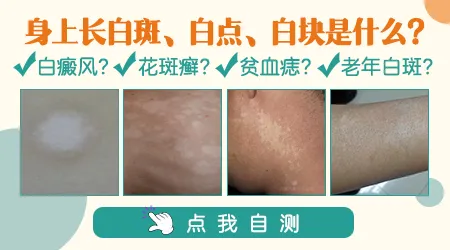 手上白斑摸起来光滑无瘙痒有可能是哪种皮肤病