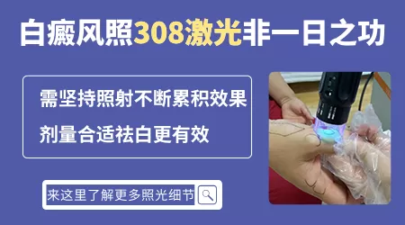 白癜风照308激光多久才会出效果