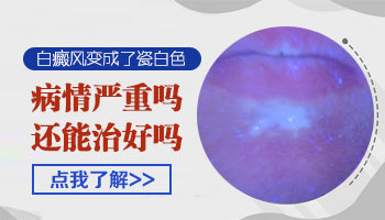 白癜风变成瓷白色了 白斑还治得好吗
