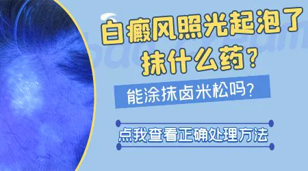 白癜风做光疗起泡后还能不能照光