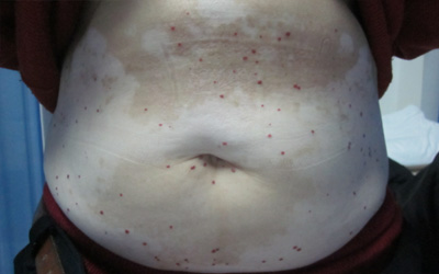 肚皮上出现白斑 是怎么回事