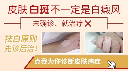 白斑和白癜风怎么肉眼区分图片