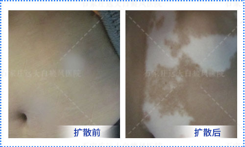 额头白斑两个月了做哪些检查