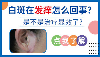 科诺白癜风光疗仪器做完发痒什么原因