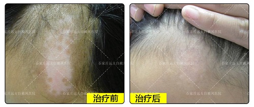 头上要是长了白癜风会是什么样子