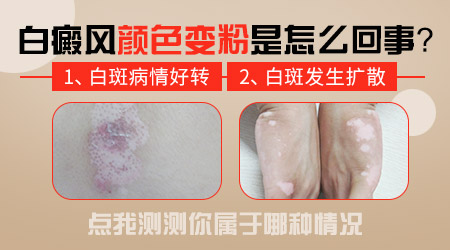 白癜风经过激光治疗后白斑变成粉红色