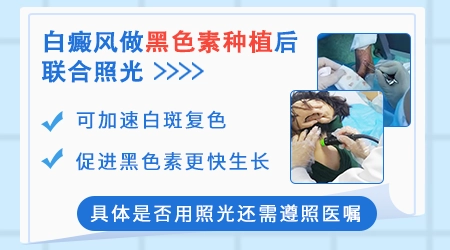 白癜风植皮多少天开始照光