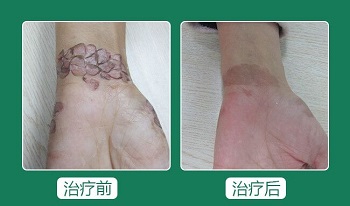 哪的白癜风黑色素培植技术做的好