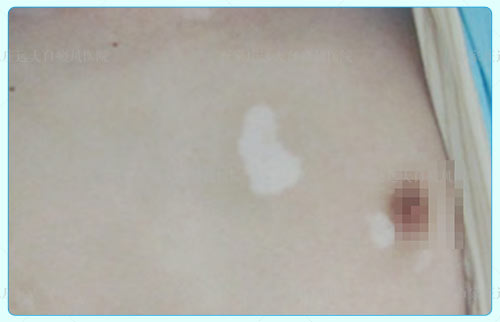 胸口白斑的早期图片