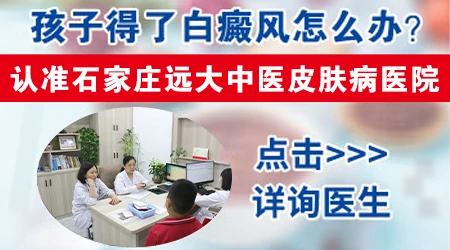 石家庄哪家医院治儿童白癜风专业