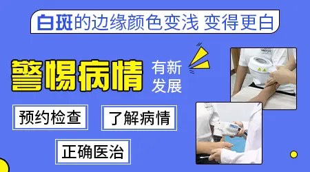 白癜风照uvb光后白斑更白了是什么情况