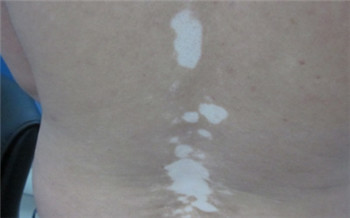 小孩子身上长了白点