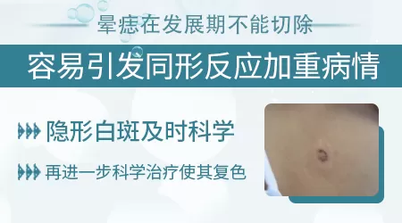 晕痣不是稳定期能切除吗