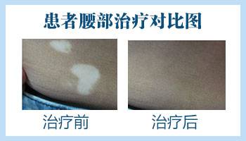 后腰靠下点有白斑一年多了还扩散怎么回事