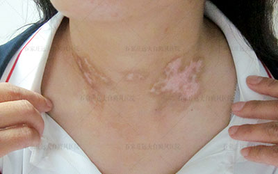 白癜风用手搓会不会变红 不红是白癜风吗