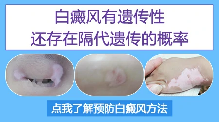 爷爷白癜风会不会隔辈遗传