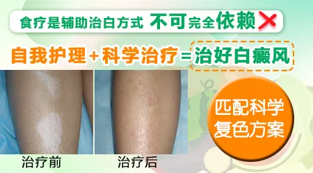 白癜风偏方吃黑色食物能复色吗