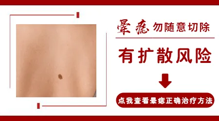 晕痣白癜风把痣切掉好还是不切