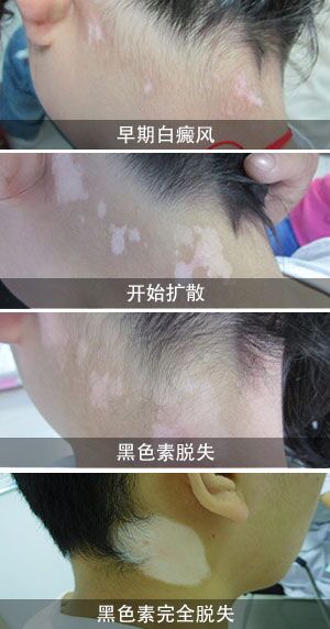 山西治疗白斑 太原白癜风医院