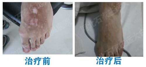 白癜风照光给报销吗