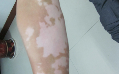 手臂上有白癜风能做种植手术吗